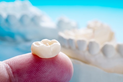 CEREC Technology: Revolutionizing Crown Installation Services in Calgary