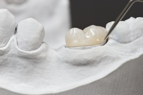 CEREC Technology: Revolutionizing Crown Installation Services in Calgary