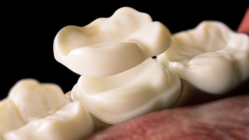 CEREC Technology: Revolutionizing Crown Installation Services in Calgary