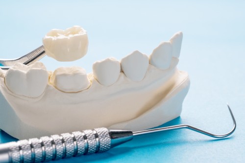 CEREC Technology: Revolutionizing Crown Installation Services in Calgary